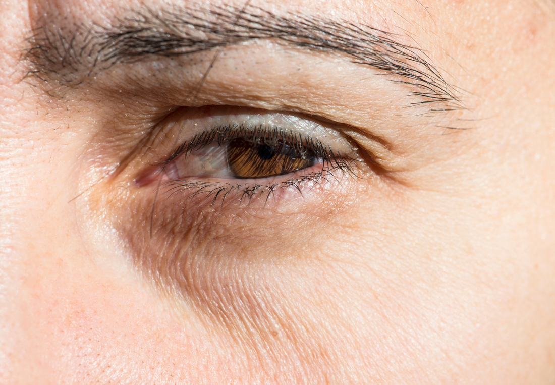 Trockene Haut unter den Augen: Ursachen